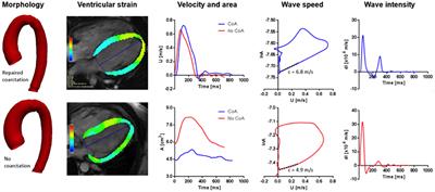 Wave Reflection and Ventriculo-Arterial Coupling in Bicuspid Aortic Valve Patients With Repaired Aortic Coarctation